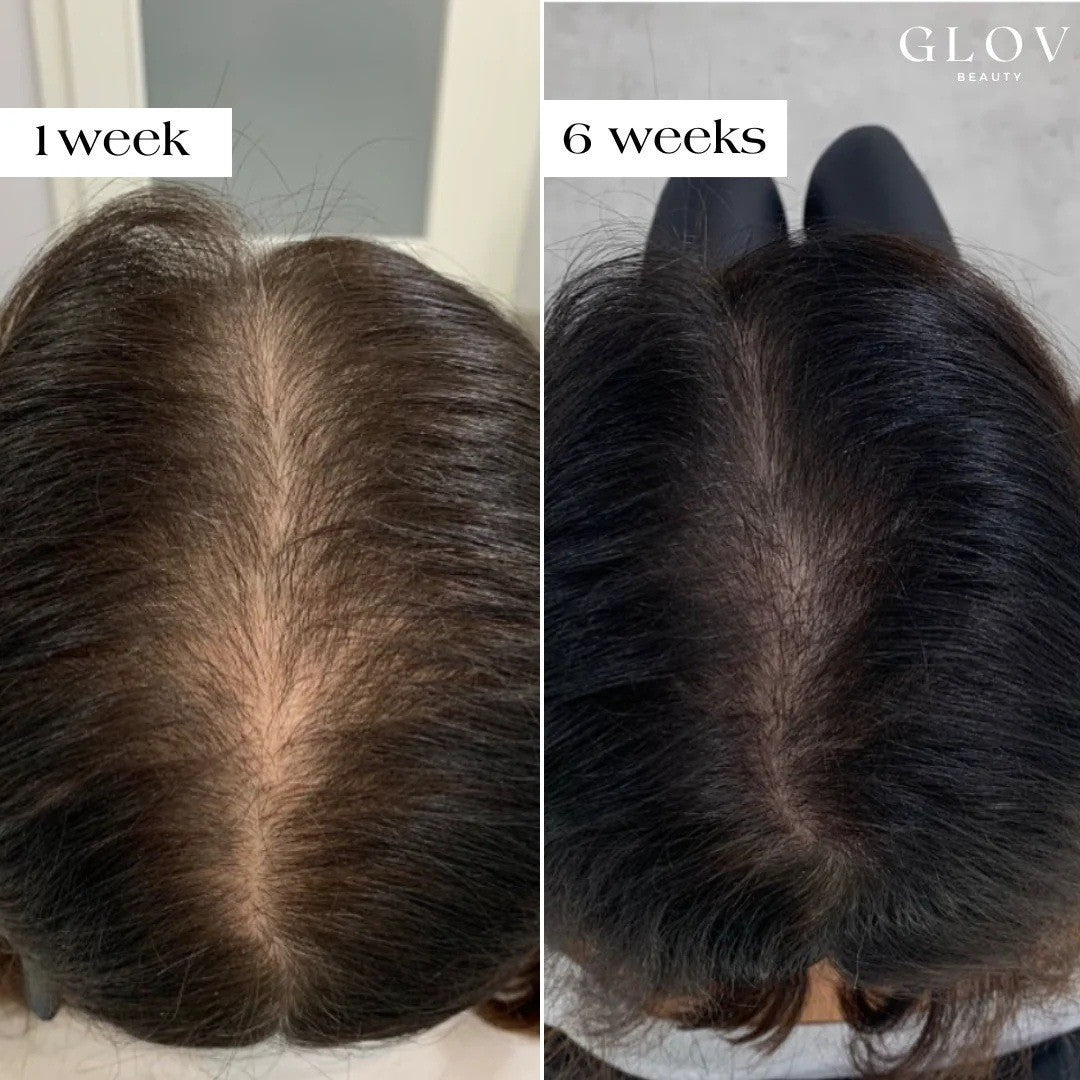 Microneedles de croissance des cheveux 2-6