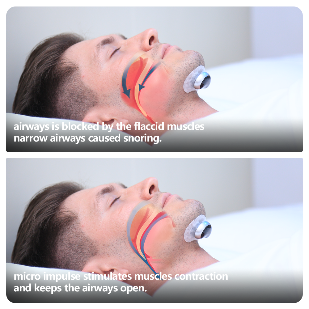 Dispositif anti-ronflement intelligent Stimulateur musculaire électronique plus avec des bandes conductrices de 20pcs